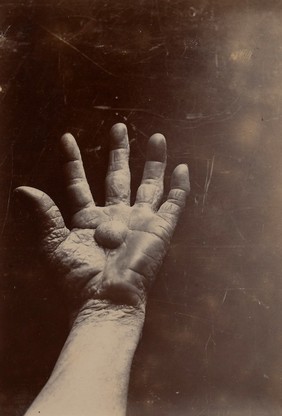 Palm of the left hand of a man suffering from chiro-pompholyx