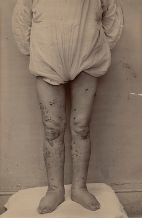 Front of the legs of an old man with Hebra's sarcoma melanoides