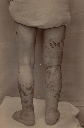 Back of the legs of an old man with Hebra's sarcoma melanoides