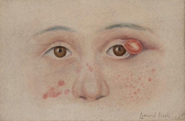 Child with xanthelasma