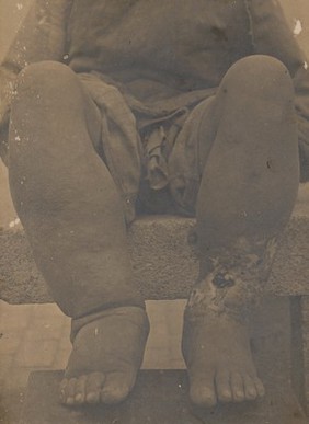 Native of China with elephantiasis of the legs