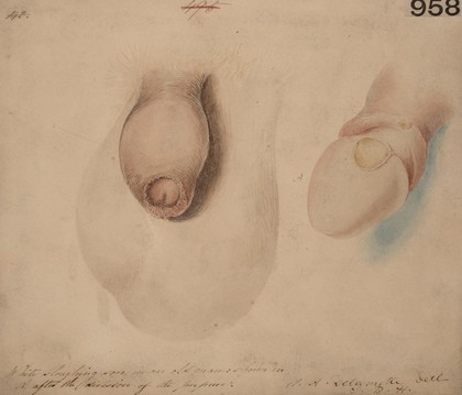 White, sloughing sore on the glans penis of an old man