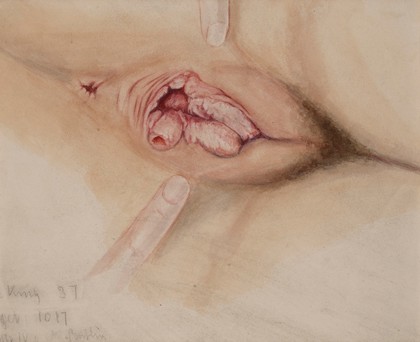 Leukoplakia and epithelioma of the vulva