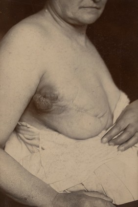 Recurrent sarcoma of the breast