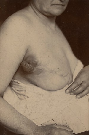 view Recurrent sarcoma of the breast