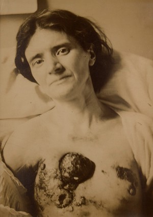 view Patient who had a recurrent carcinoma of the right breast