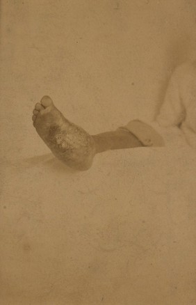 Foot of an Egyptian affected with mycetoma