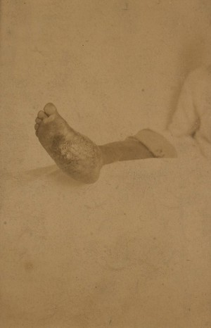 view Foot of an Egyptian affected with mycetoma