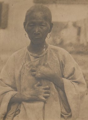 Chinese leper