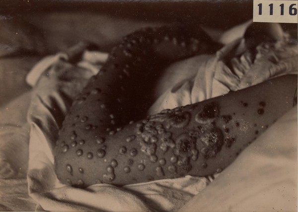 Left arm of a child showing concurrent smallpox and vaccination, 10th day