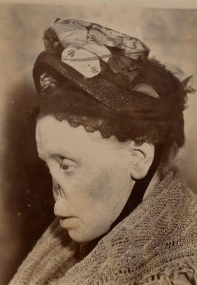 Face of a woman with a typical 'syphilitic nose'