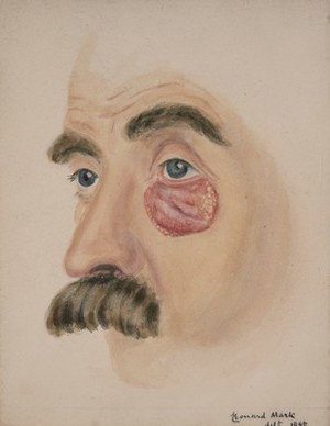 view Tertiary syphilitic ulcer on the lower eyelid