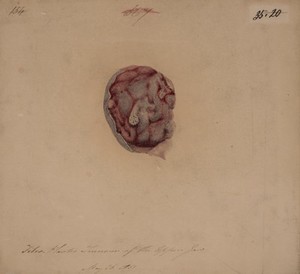 view Myeloid (fibro-plastic) tumour in an upper jaw