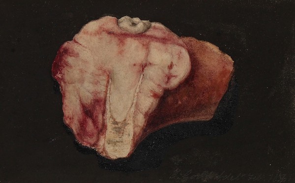 Myeloid sarcoma of the inferior maxilla