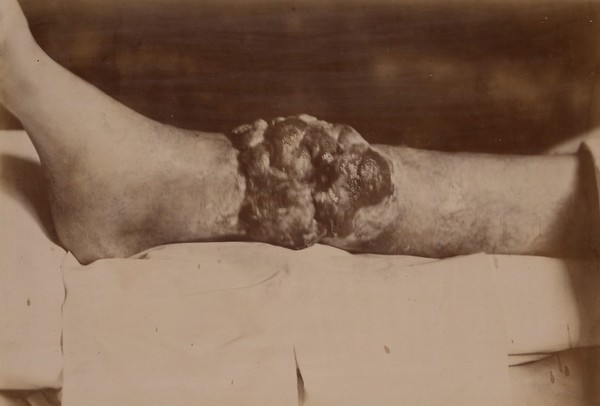 Sarcoma which developed upon a chronic ulcer of the leg