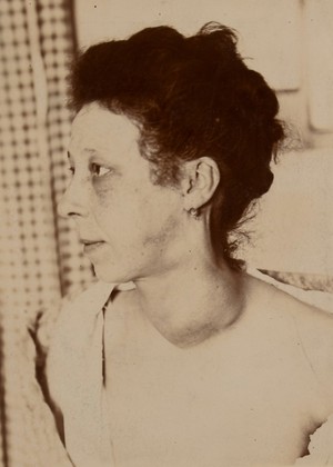 view Woman with a large tumour in the neck