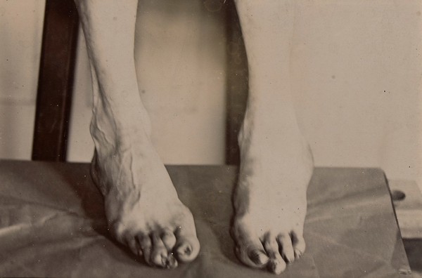 Congenital deformity of the feet