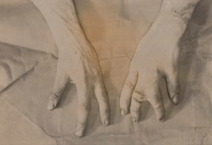 view Congenital deformity of the hands
