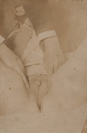 External genitalia of a man suffering from hypospadias