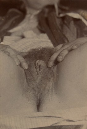 External genitalia of a man suffering from hypospadias