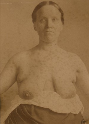 view Woman with supernumery breasts and nipples