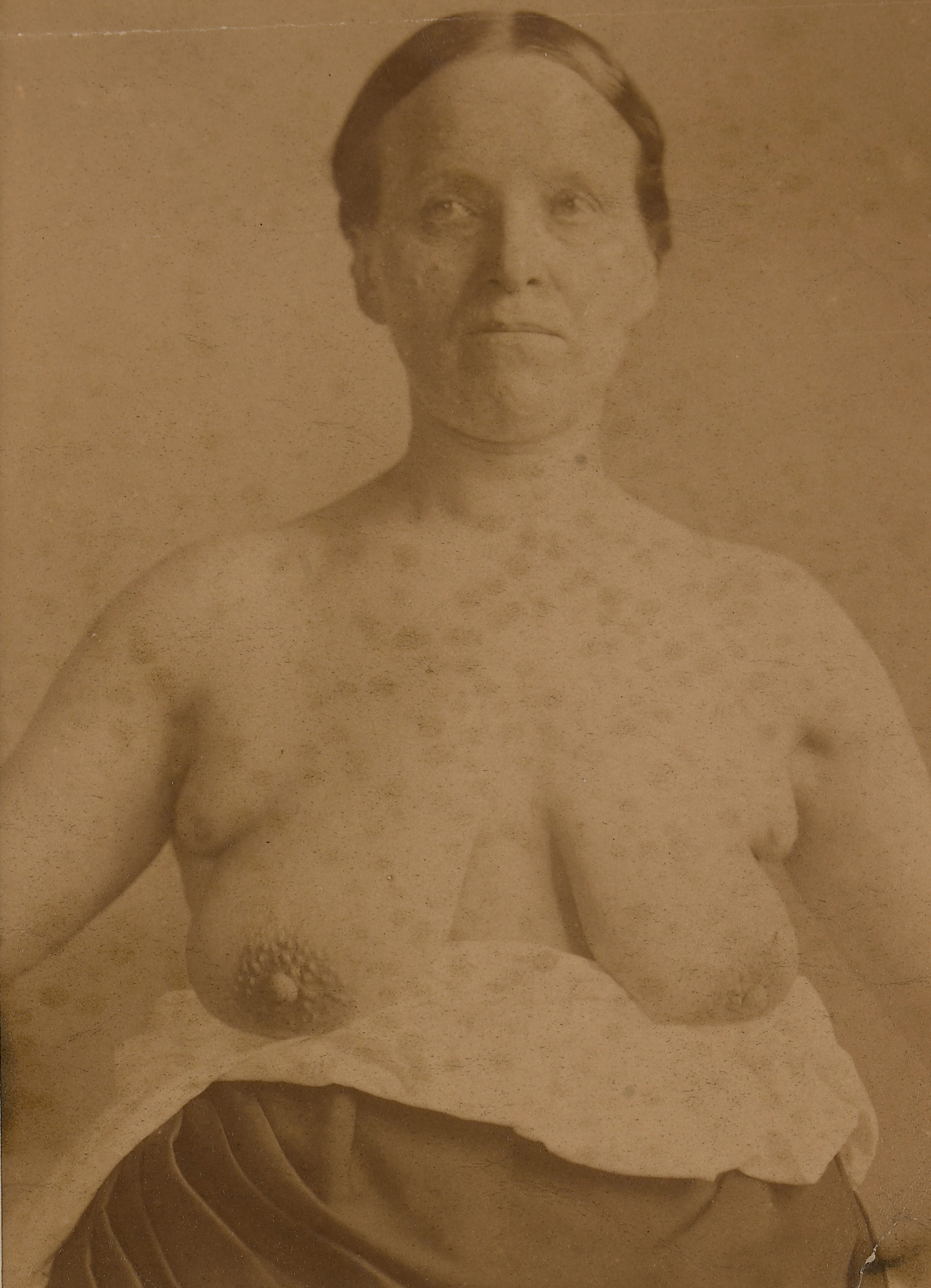 Woman with supernumery breasts and nipples