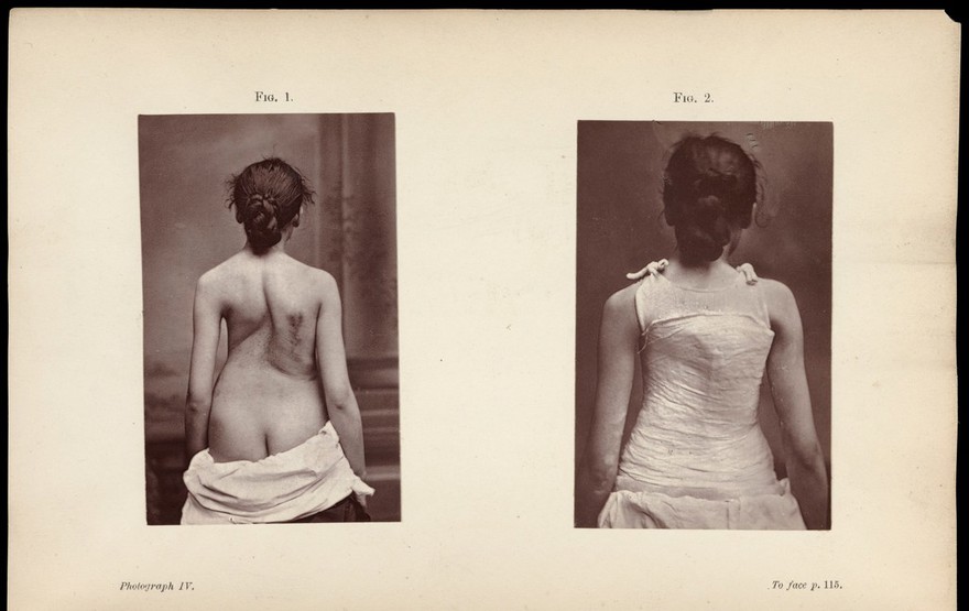 Spinal disease and spinal curvature : their treatment by suspension and the use of the plaster of Paris bandage / by Lewis A. Sayre.