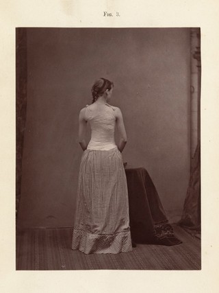 Spinal disease and spinal curvature : their treatment by suspension and the use of the plaster of Paris bandage / by Lewis A. Sayre.