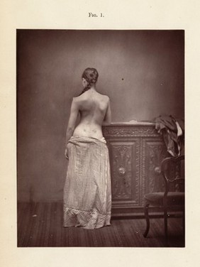 Spinal disease and spinal curvature : their treatment by suspension and the use of the plaster of Paris bandage / by Lewis A. Sayre.