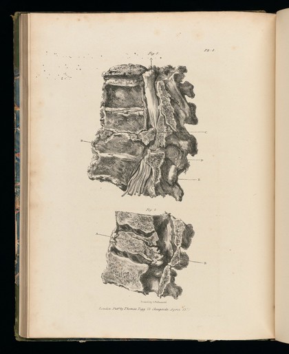 Observations on injuries of the spine and of the thigh bone: in two lectures. Delivered in the school of Great Windmill street / [Sir Charles Bell].