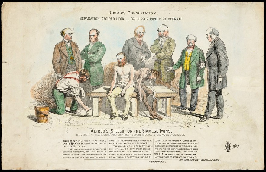 Professors considering whether a pair of conjoined twins should be separated after the death of one of them; representing a political discussion in Bradford about the separation of two factions (?). Coloured lithograph, 1868.