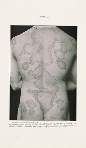 view Areas of psoriasis on the back of a thirty year old man. Process print after a photograph, ca. 1905.