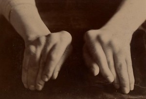 view Curious congenital deformity of the hands