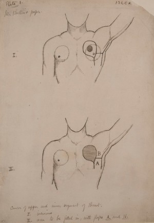 view Methods of arranging skin flaps after mastectomy operations (plate 1)