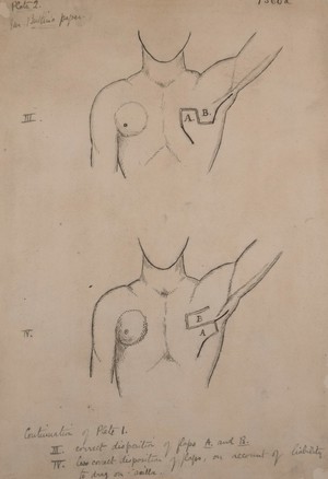 view Methods of arranging skin flaps after mastectomy operations (plate 2)