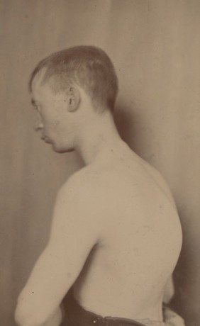 Man suffering from thoracic kyphos