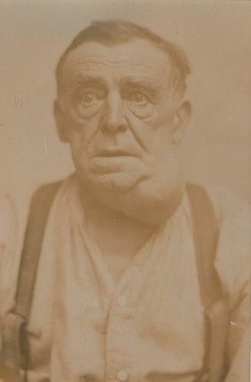 Man with a tumour of the neck