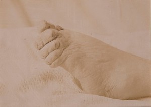 view Deformity of the foot and toes