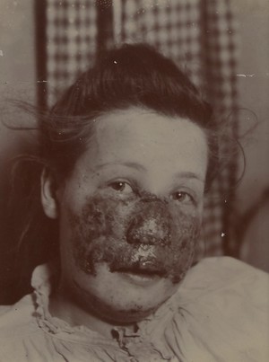 view Face of a woman suffering from lupus