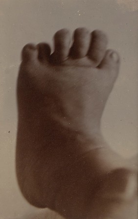 Infant's foot with six toes