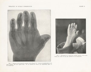 view Skiagram and photograph of a hand showing brachydactylism, plate D in Treasury of Human Inheritance, edited by Karl Pearson, London, Dulau and Co, 1912
