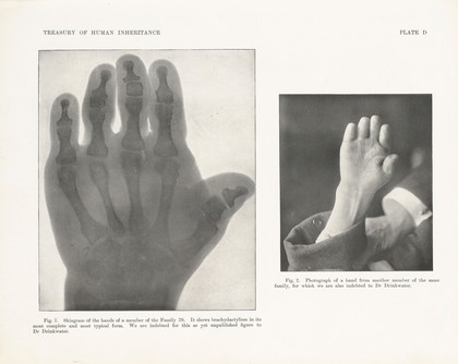 Skiagram and photograph of a hand showing brachydactylism, plate D in Treasury of Human Inheritance, edited by Karl Pearson, London, Dulau and Co, 1912