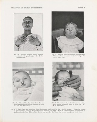 Examples of hare-lip or congenital recesses of the lower lip, plate K in Treasury of Human Inheritance, edited by Karl Pearson, London, Dulau and Co, 1912
