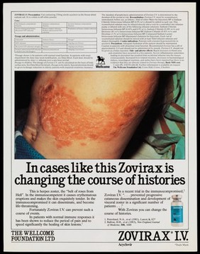 Zovirax advert.