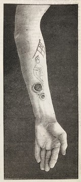 Signs of syphilis on the site of a tattoo