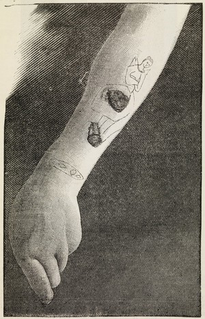 view Signs of syphilis on the site of a tattoo