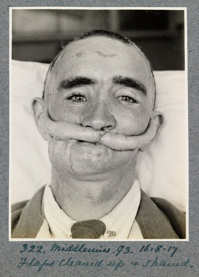 WW1 Plastic surgery cases | Wellcome Collection