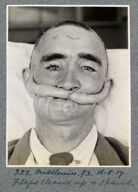 WW1 Plastic surgery cases