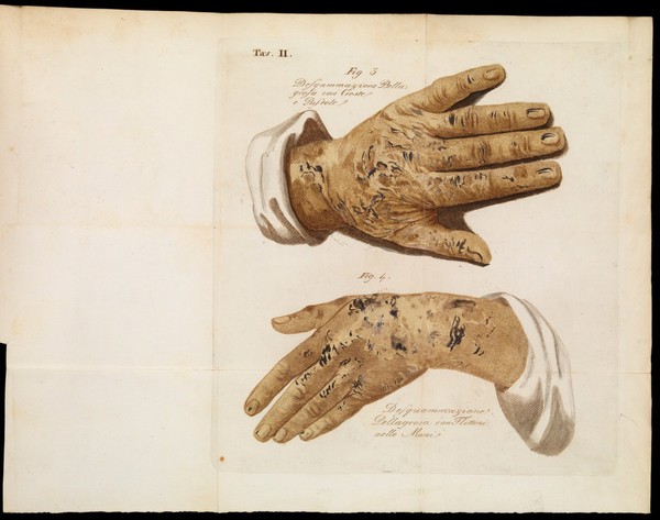 Saggio di ricerche sulla pellagra / Di Vincenzio Chiarugi.
