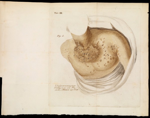 Saggio di ricerche sulla pellagra / Di Vincenzio Chiarugi.
